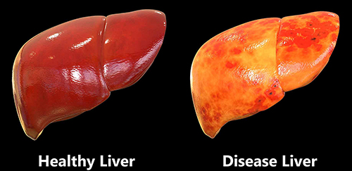 Fatty Liver Reversal