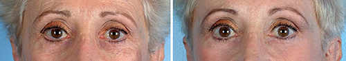 PMD Beauty Reversal Pore Serum
