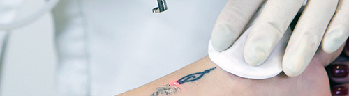 What is Laserless Tattoo Reversal